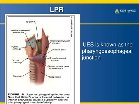 Ppt Laryngopharyngeal Lpr Reflux And Gerd Powerpoint Presentation