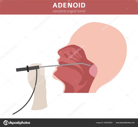 Nasal And Throat Nasopharynx Diseases Adenoids Diagnosis And T Stock