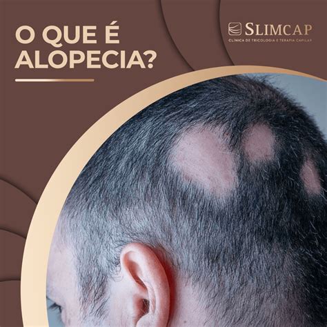 O Que Alopecia Como Identificar E Tratar Slimcap