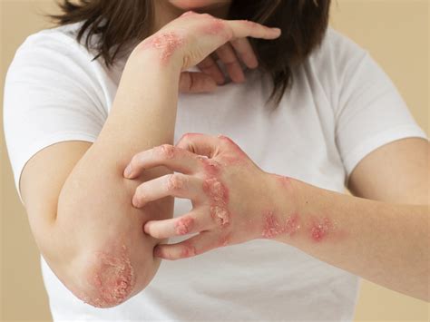 Eczema Numular Causas Sintomas e Possíveis Tratamentos