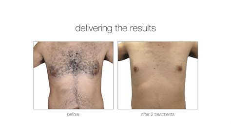 Laser Hair Removal North Vancouver 4d Skin Care Clinic