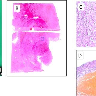 Macro And Microscopic Findings Of The Resected Specimen A Macroscopic