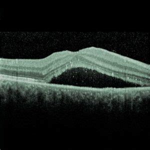 Retinopathia centralis serosa Augenärzte am Dom Makula Netzhaut