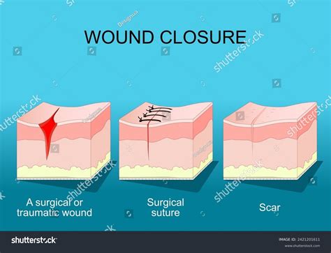 Wound Healing Skin Before After Wound Stock Vector Royalty Free