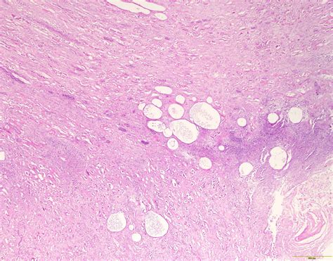 Chronic Pyelonephritis Histology