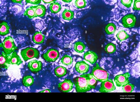 Herpes Simplex Viruses Coloured Transmission Electron Micrograph Tem