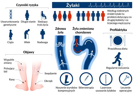 Widoczne żyły na nogach wskazanie do konsultacji Ars Estetica