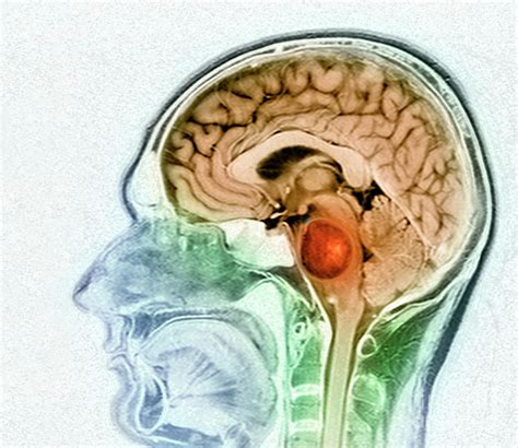 Brain Tumour Photograph By Simon Fraser Science Photo Library Fine