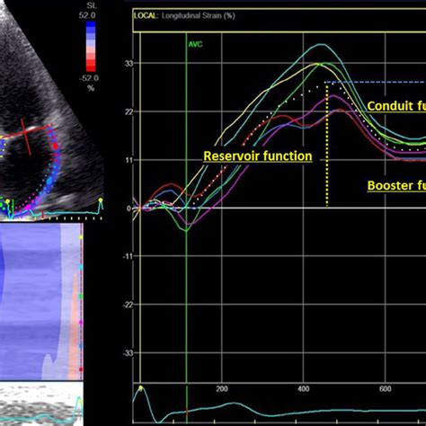 Two Dimensional Speckle Tracking Strain Analysis Of Left Atrial La