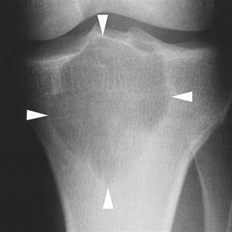 Chondroblastoma Radiology