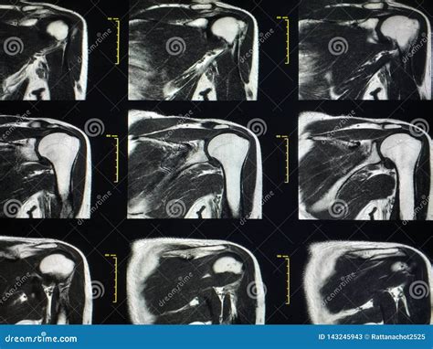 Shoulder MRI Scan Magnetic Resonance Image High Resolution Stock Image