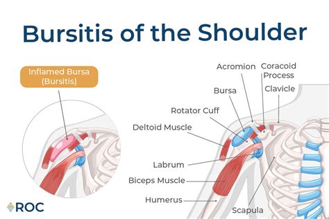 Understanding Bursitis Of The Shoulder Causes Symptoms And Treatment