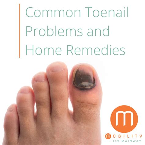 Common Toenail Problems and Home Remedies