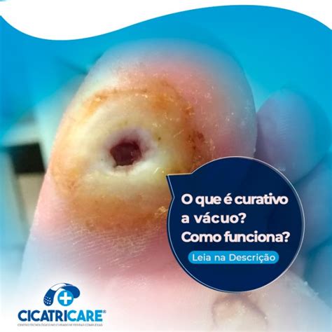 O que é curativo a vácuo Como funciona Os Recomendados