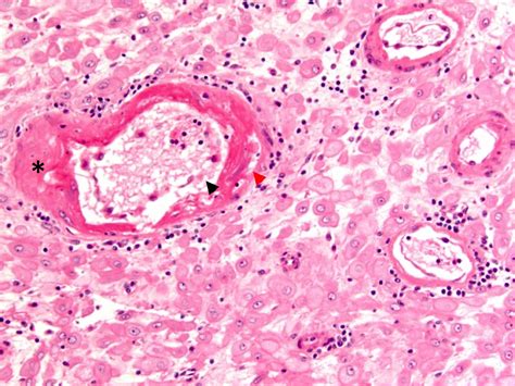 Pathology Outlines Maternal Vascular Malperfusion