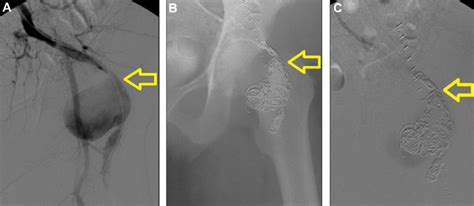 A Pre Embolization Angiography Left Internal Iliac Artery With