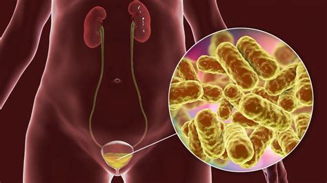 Familia Y Salud Cistitis Y Otras Infecciones Uabc Radio Hot Sex Picture