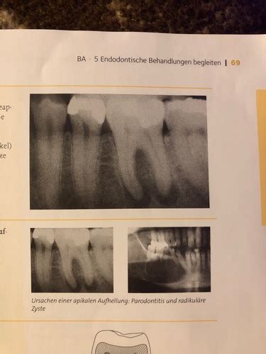 Kariesfolgen Und Vitalerhaltung Der Pulpa Karteikarten Quizlet