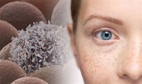 Skin cancer: When your freckles could be a sign of the deadly condition ...