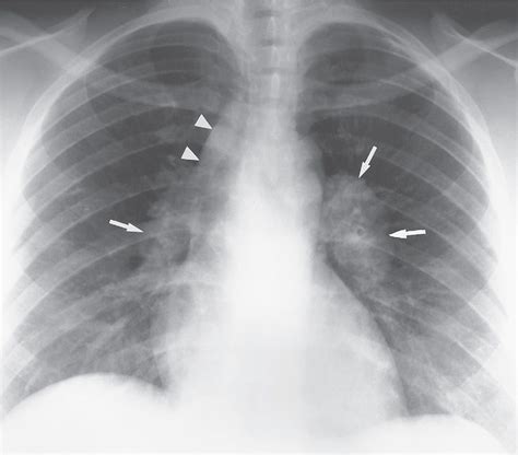 Silicosis Eggshell Calcification