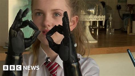 Meningitis Survivor Tilly Lockey Gets Bionic Hands Bbc News