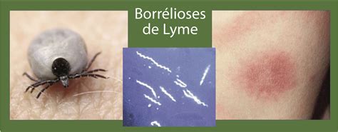 Borrélioses de Lyme maladies infectieuses complexes Santé Vivante