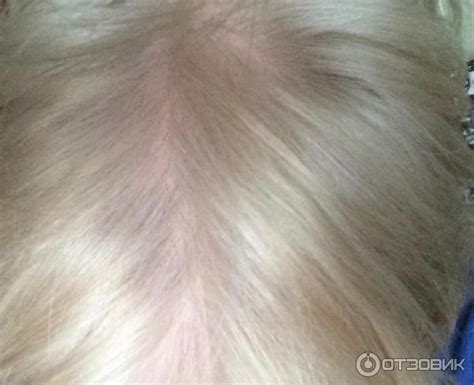 Отзыв о Мезотерапия головы и волос MD Skin Solutions Mesoline Hair ...