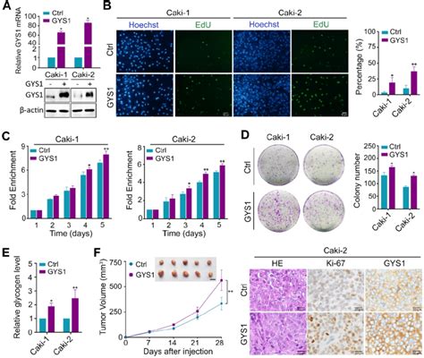 GYS1 Promotes CcRCC Proliferation In Vitro And In Vivo A GYS1 Was