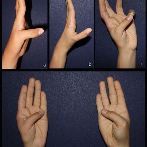 PDF HYPOPLASTIC THUMB TYPE IIIB AN ALTERNATIVE METHOD FOR SURGICAL