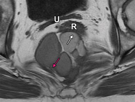 Mri Of Tumors And Tumor Mimics In The Female Pelvis Anatomic Pelvic