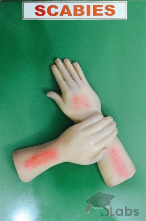 Scabies Scholars Labs