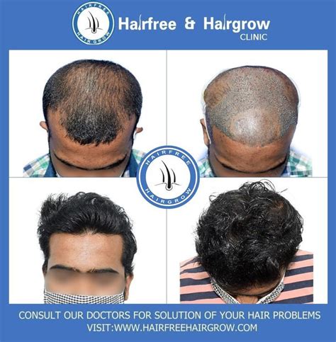 Best Hair Transplant In Pune Artofit