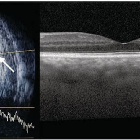 Left The B‐scan Ocular Ultrasound Image Of Case 1 Obtained 2 Days