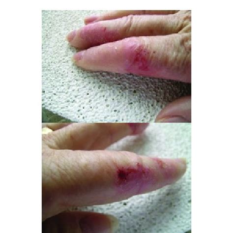 (A) Skin lesions on the hand of a Morgellons disease patient. (B) Skin... | Download Scientific ...