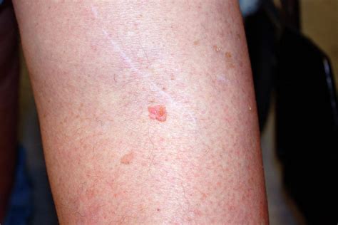 Squamous Cell Carcinoma On Leg