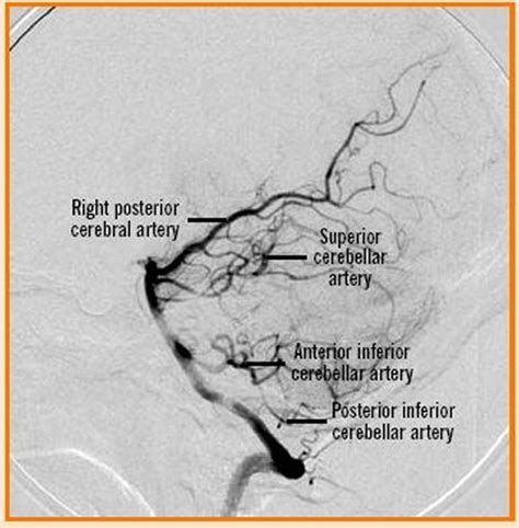 Vertebral Artery Segments Stenosis And Artery Dissection Symptoms