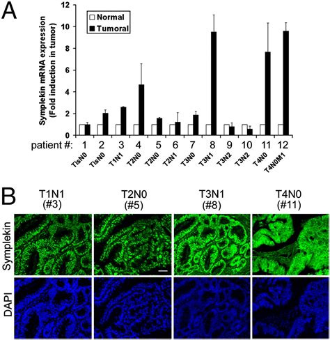 Symplekin Promotes Tumorigenicity By Up Regulating Claudin 2 Expression