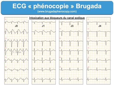 Syndrome De Brugada Dg Diff Rentiels E Cardiogram