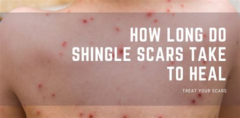 How Long Do Shingle Scars Take To Heal Treat Your Scars