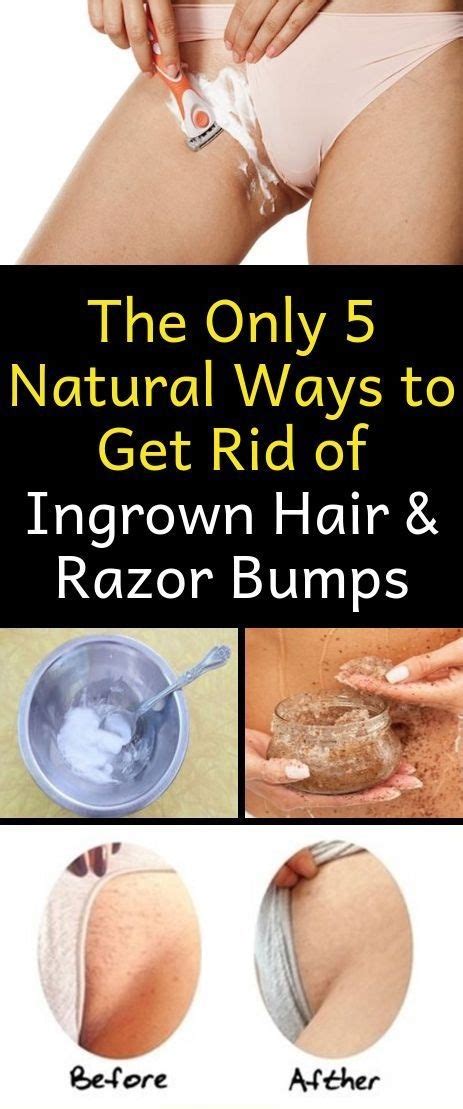 How To Get Rid Of Razor Bumps On Bikini Area Naturally Alorabarbie