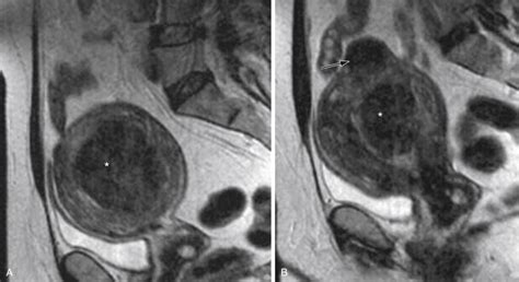 Magnetic Resonance Guided Ultrasound Surgery Of Uterine Leiomyomas