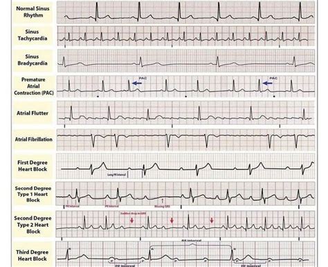 Common Heart Rhythms Medizzy