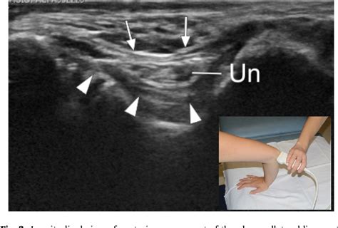 Figure 3 From Ultrasound Of The Elbow With Emphasis On Detailed