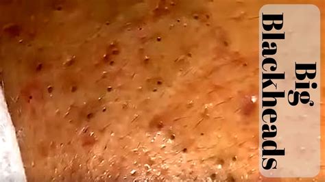 Big Blackheads - YouTube