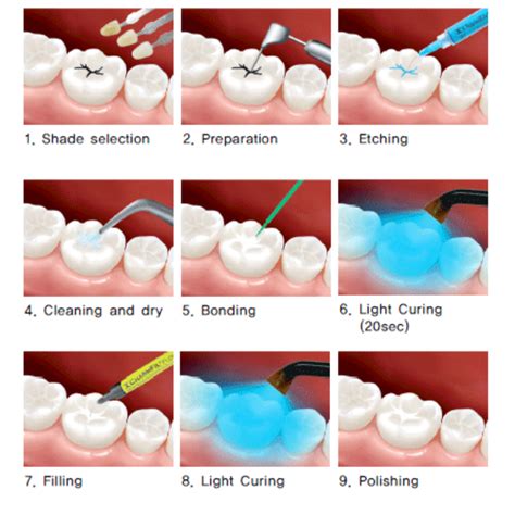power  composite    teeth filling front teeth
