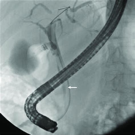 Cholangiography Showing A Tubular Filling Defect White Arrow With