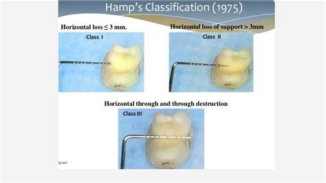 Furcation Involvement Periodontology 2pptx