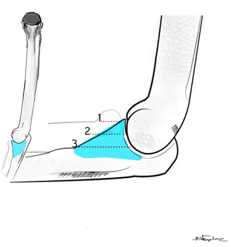 Coronoid Process Fracture The Bone School