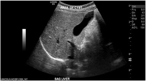 Liver Cyst Ultrasound