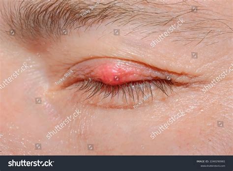 Eyelash Demodicosis Mite Diseas Demodex Chalazion Foto Stock 2240290981